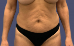 Abdominoplasty (Tummy Tuck) 1 Before